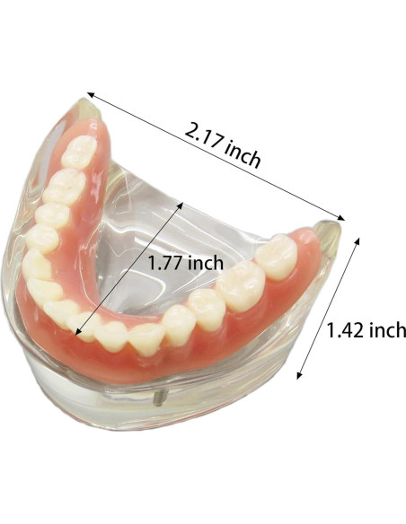 Modelo Dental Typodont M6002 con Sobredentadura y 2 Implantes