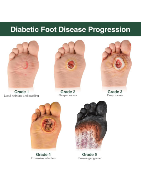 Modelo de Cuidado del Pie Diabético 5 Pcs Ultrassist - Simulador Grado 1-5
