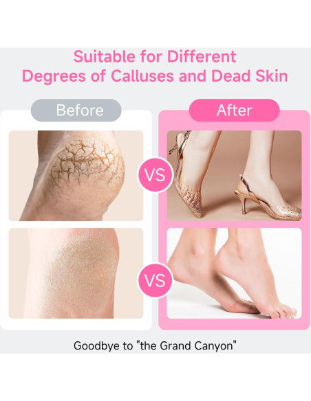 Removedor de Callos Eléctrico iRnergy con 60 Discos de Lija