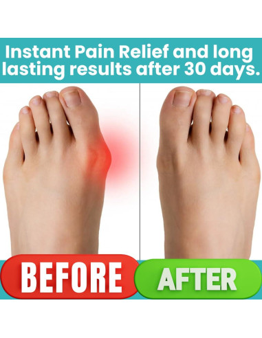 Corrector de Juanetes ONERVA 2PC Alivio Hallux Valgus