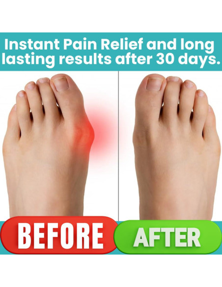 Corrector de Juanetes ONERVA 2PC Alivio Hallux Valgus