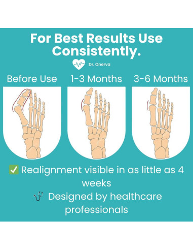 Corrector de Juanetes ONERVA 2PC Alivio Hallux Valgus