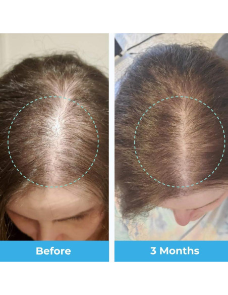 Vitaminas Postparto para Pérdida de Cabello Baby Blues - Gominolas Veganas con Biotina y Colágeno