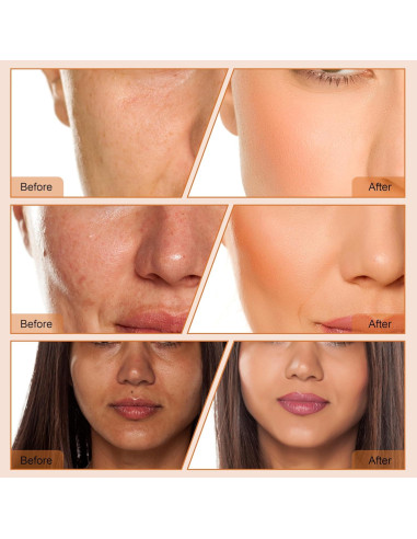 Máquina de Microdermoabrasión de Diamante ET33P4 con Manguera