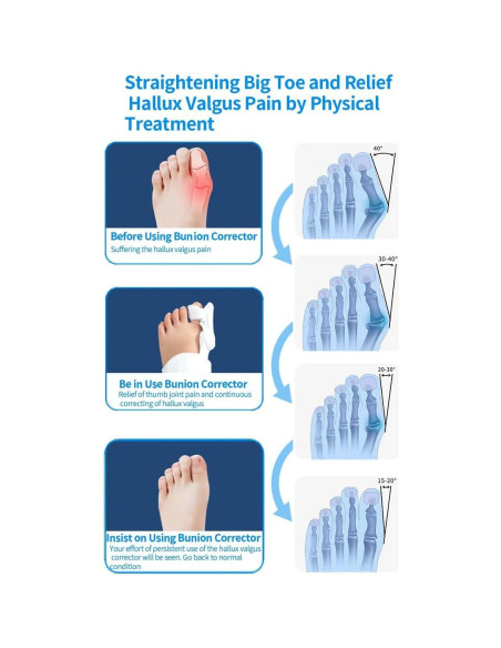Corrector de Juanetes Ajustable XREKNOi Modelo 02 para Alivio