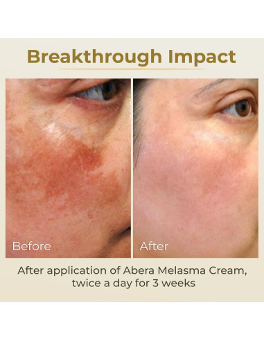 Crema Correctora de Manchas Oscuras Abera 19.84g - Melasma