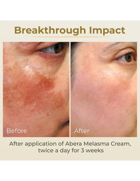 Crema Correctora de Manchas Oscuras Abera 19.84g - Melasma