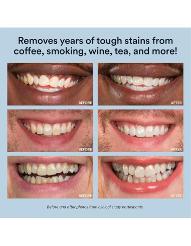 Kit de Blanqueamiento Dental Auraglow LED 35% Carbamida 20 Tratamientos