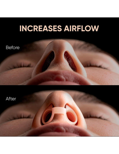 Dilatadores Nasales Anti Ronquidos Commanding Life - 8 Piezas