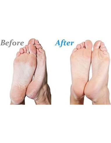 Emjoi Micro-Pedi Power Removedor de Callos Eléctrico Azul