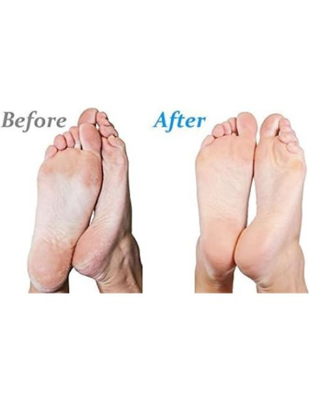 Emjoi Micro-Pedi Power Removedor de Callos Eléctrico Azul