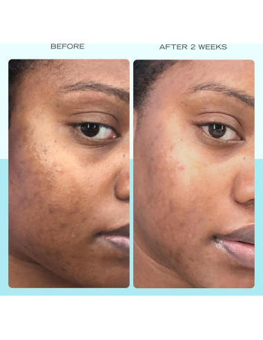 Suero para Manchas Oscuras First Aid Beauty 29.57 ml Niacinamida