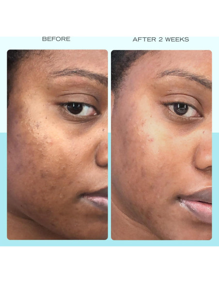 Suero para Manchas Oscuras First Aid Beauty 29.57 ml Niacinamida