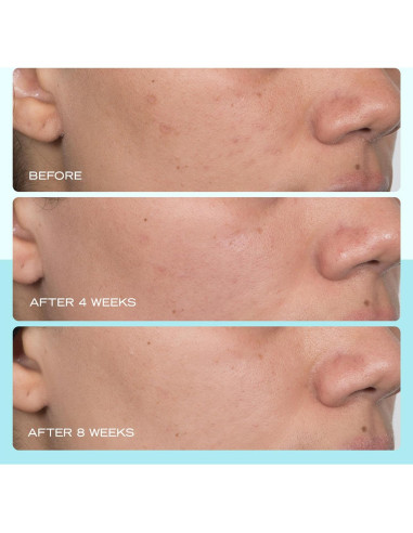 Suero para Manchas Oscuras First Aid Beauty 29.57 ml Niacinamida