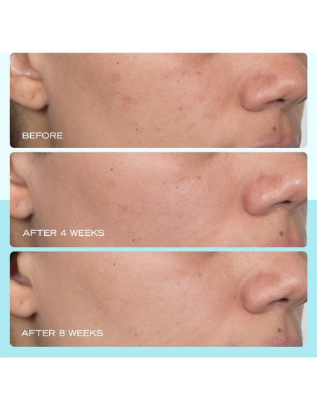 Suero para Manchas Oscuras First Aid Beauty 29.57 ml Niacinamida