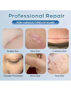 Gel de Silicona Glowor para Cicatrices 49.87g - Acné, Quemaduras 2