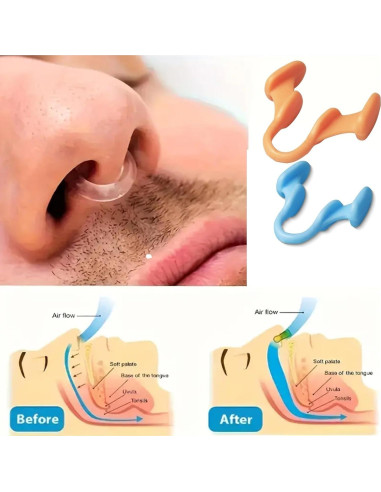 Diluidor Nasal Antironquidos Genérico 6 Piezas - Respiración Fácil