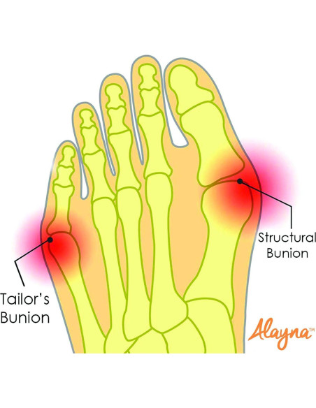 Correctores de Juanetes Alayna Gel Unisex - Alivio y Soporte