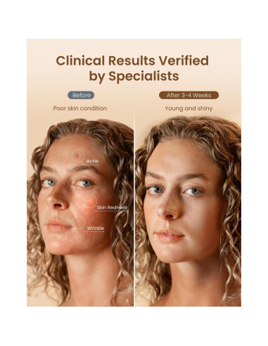 Máscara de Terapia de Luz Roja RENPHO E100B 324 LEDs 3 Modos