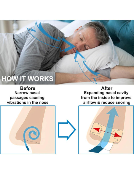 Dilatores Nasales Antirronquido UyiCare - Paquete de 4 Clips