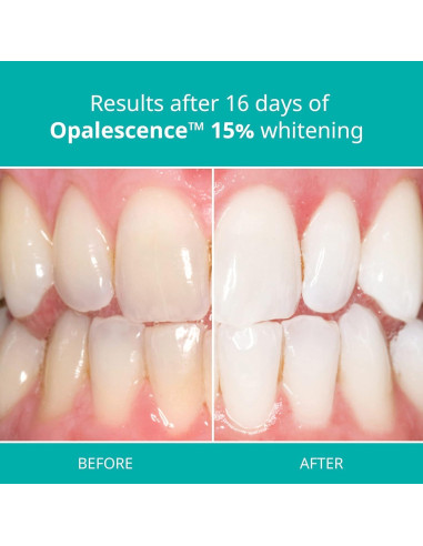 Kit de gel blanqueador dental Opalescence 15% - 4 jeringas