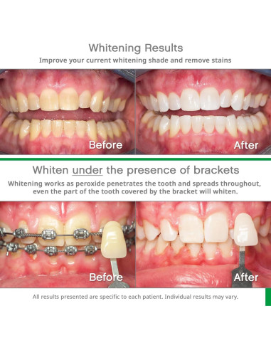 Opalescence GO 15% - 10 Kits Blanqueamiento Dental Menta