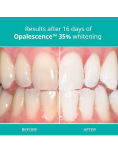 Kit Blanqueamiento Dental Opalescence 35% - 4 Jeringas 2