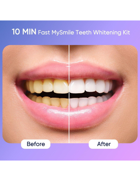 Kit Blanqueamiento Dental MySmile Deluxe 10 Min 28 LED
