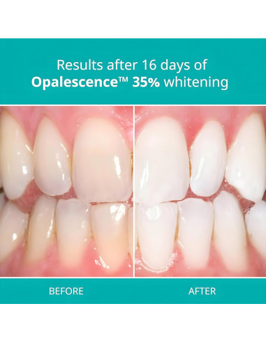 Gel Blanqueador Dental Opalescence 35% - 4 Jeringas Melón