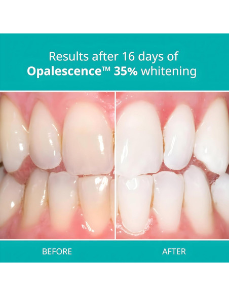 Gel Blanqueador Dental Opalescence 35% - 4 Jeringas Melón