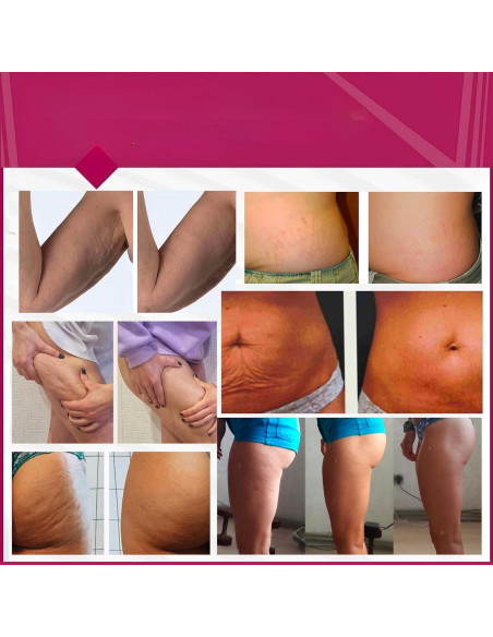 Crema Gel Corporal Anti-Celulitis Anacis 143 g - Efecto Caliente