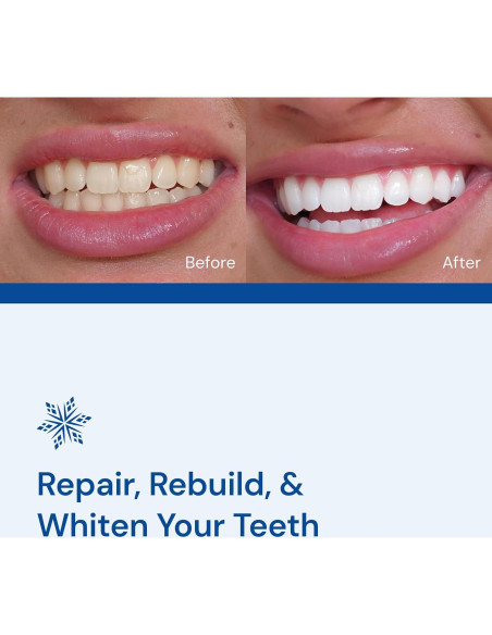 Kit de Blanqueamiento Dental Snow - Suero LED y Boquilla