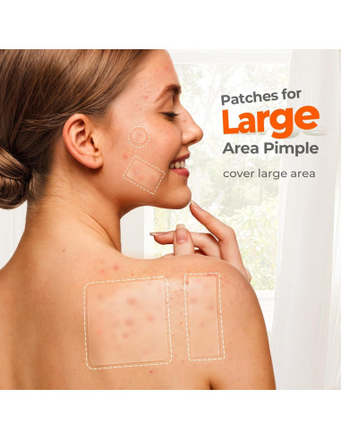 Parches para Acné TKTK - 126 Parches Hidrocoloides XL