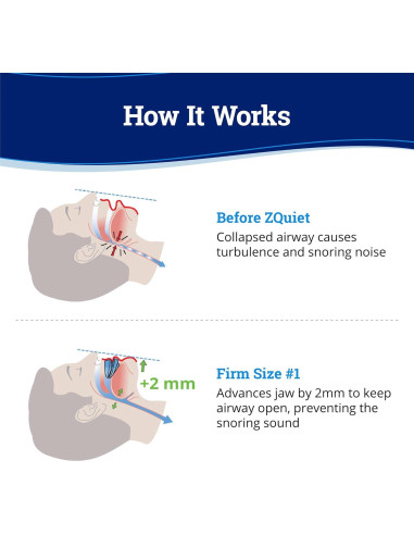 Protector Bucal Antisnoring ZQuiet Firme 1 - Duradero y Efectivo