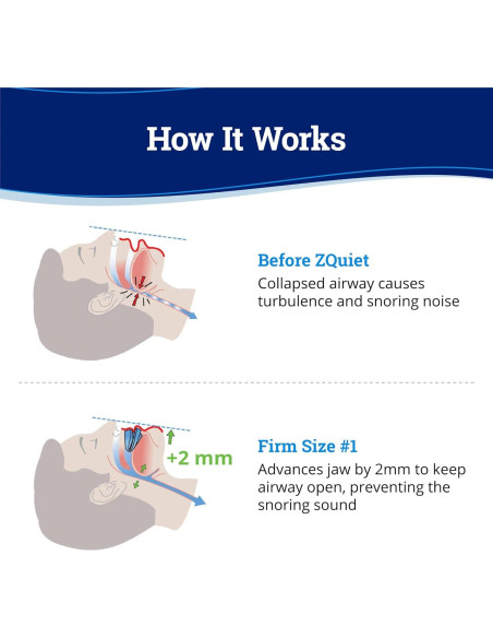 Protector Bucal Antisnoring ZQuiet Firme 1 - Duradero y Efectivo