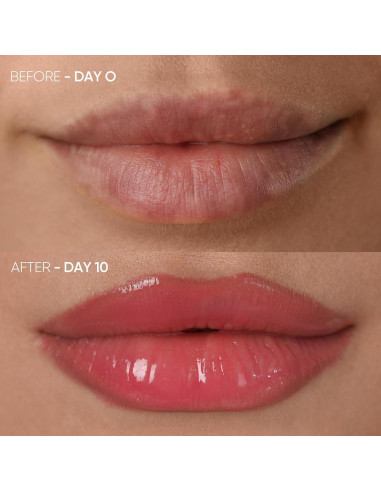 Dispositivo de Aumento de Labios LED Estanana - Terapia Luz Roja