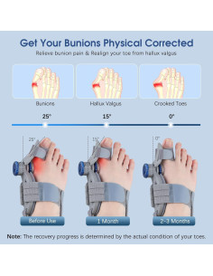 Corrector de Juanetes KASHEVI Ajustable para Alivio Dolor 2