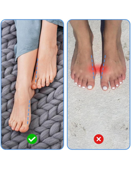 Corrector de Juanetes PEOVLVN 2 Pcs Dedo Grande Alivio