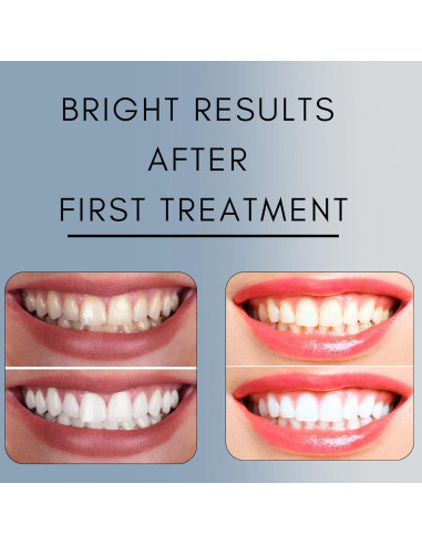 Gel Blanqueador Dental Cool 44% Peróxido Carbamida - 50 Tratamientos