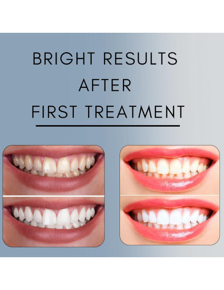 Gel Blanqueador Dental Cool 44% Peróxido Carbamida - 50 Tratamientos