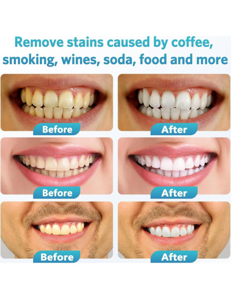 Kit de Blanqueamiento Dental BESTEK - Luz LED 32X, Gel 35% - Azul