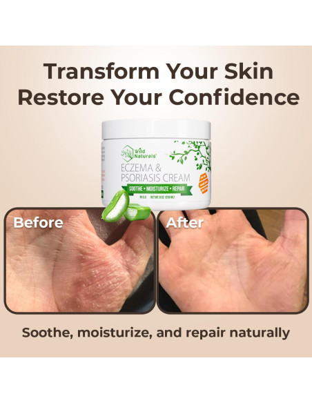 Crema Hidratante para Eczema y Psoriasis Wild Naturals 113g