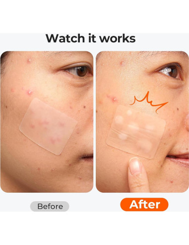 Parche para Granos TKTK Hidrocoloide 92 Parches 5 Tamaños