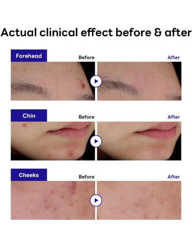 Parche Hidrocoloide Mediheal Madecassoside 132 Contadores