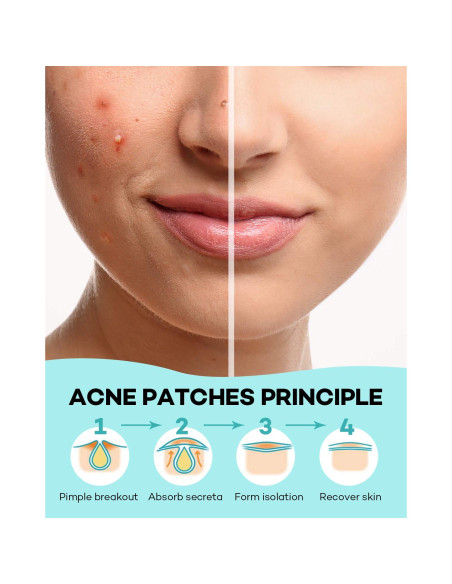 Parches para Granos TKTK - 140 Unidades Hidrocoloide