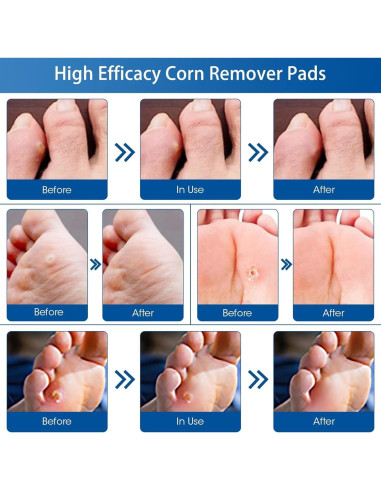 48 Almohadillas Removedoras de Callos MQUPIN - Efectivas y Naturales