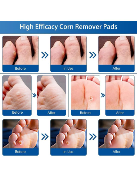 48 Almohadillas Removedoras de Callos MQUPIN - Efectivas y Naturales