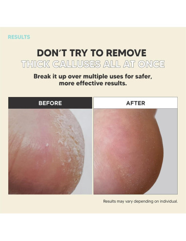 Rasuradora de Callos MAX-MATE de Acero Inoxidable Ergonómica