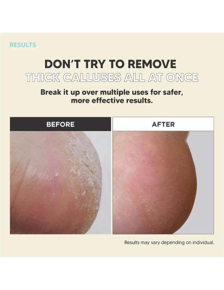 Rasuradora de Callos MAX-MATE de Acero Inoxidable Ergonómica