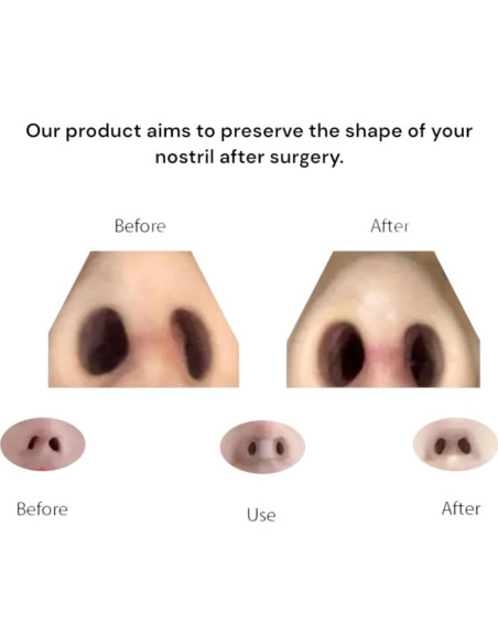 Retenedor Nasal Premium Nanovita - 2 Tamaños (5 y 6) - Silicona Médica Retenedor Nasal Premium Nanovita - 2 Tamaños (5 y 6) - Silicona Médica